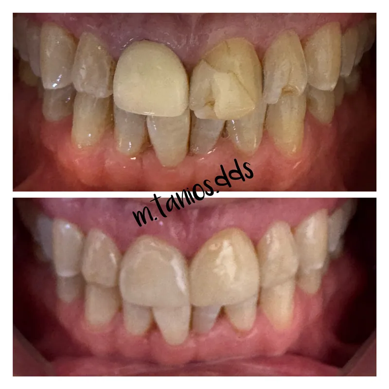 2 pictures of before and after crowns