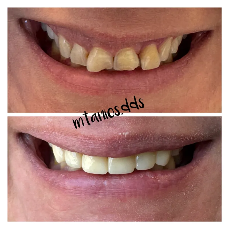 2 pictures depicting before and after crowns