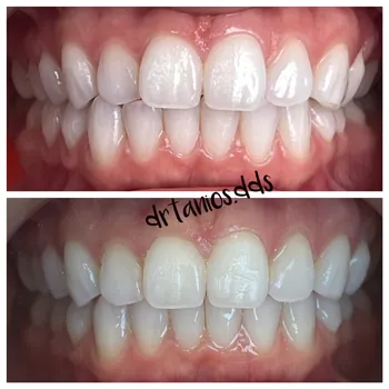 2 photos of open mouth before and after invisalign