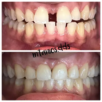 2 photos displaying open mouth before and after invisalign